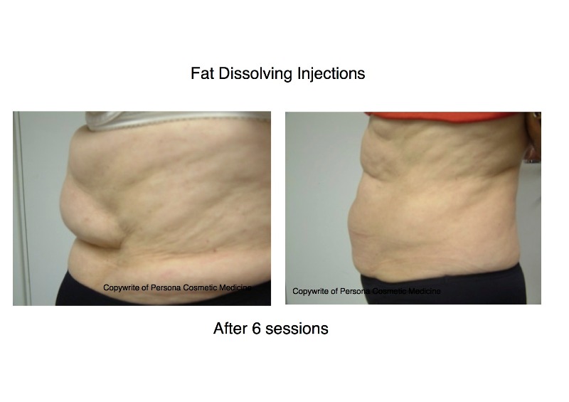 Before & After Fat Dissolving Injections Photo